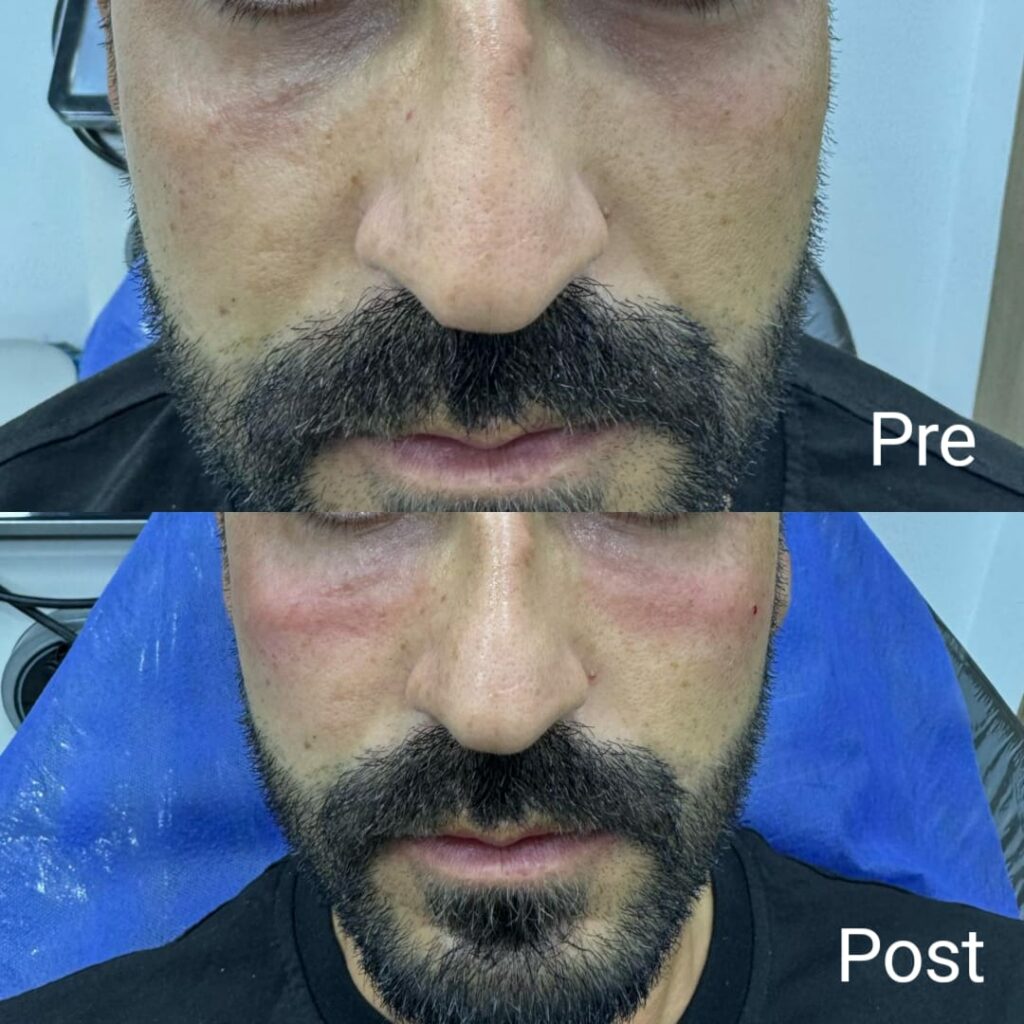 فيلر لتجويف تحت العين